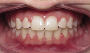 After: Patient with crowding