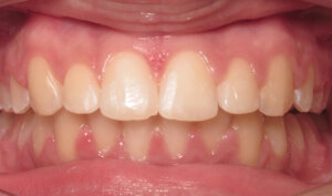 After: Patient with severe overjet, upper spacing, and lower crowding
