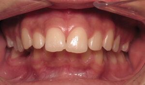 Before: Patient with severe overjet, upper spacing, and lower crowding