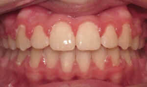 After: Patient with overjet and crowding