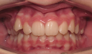 Before: Patient with overjet and crowding