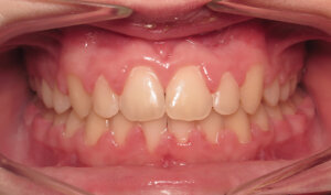 After: Patient with moderate overbite, overjet, and spacing