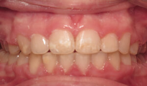 After: Patient with overjet and crowding