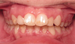 Before: Patient with overjet and crowding