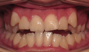 Before: Patient with overbite, openbite, and crowding