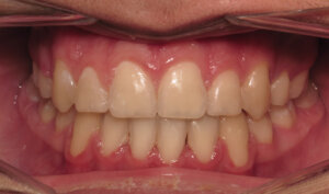 After: Patient with overbite, openbite, and crowding