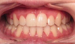 After: Patient with overbite and crowding