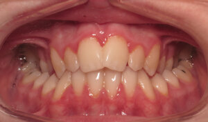 Before: Patient with overbite and crowding