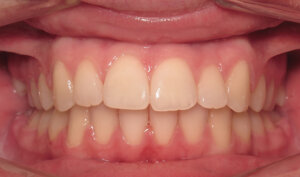 After: Patient with moderate overbite, overjet, and crowding