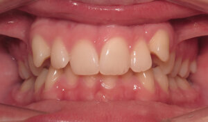 Before: Patient with moderate overbite, overjet, and crowding